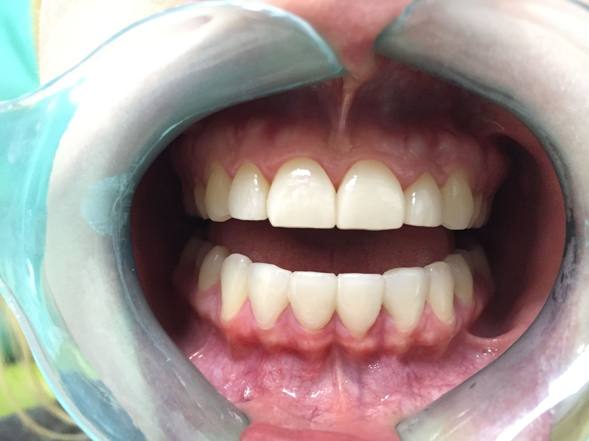 The Complete Guide to Porcelain Veneers in 2025