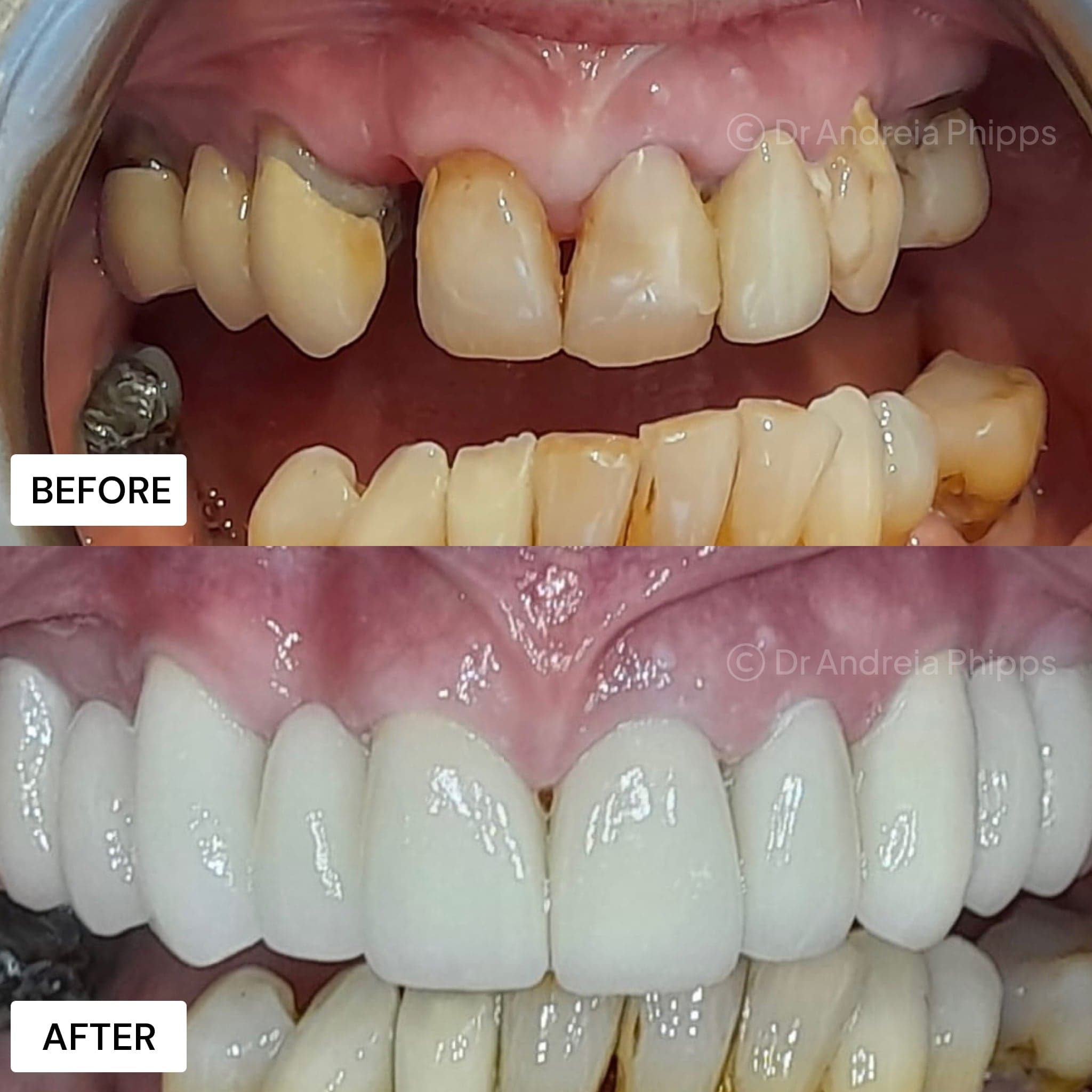 Dental Implants vs Bridges: Making the Right Choice