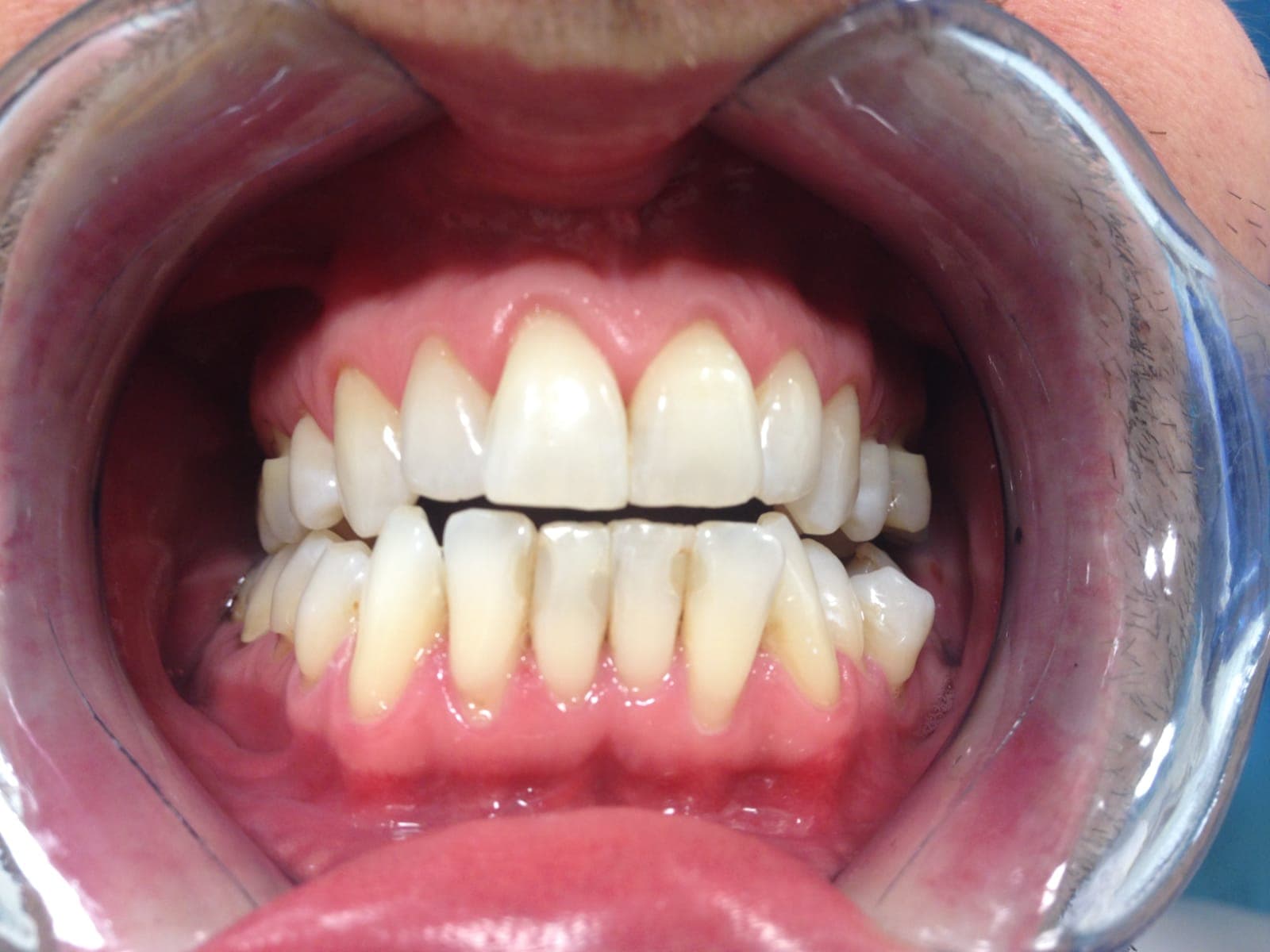 Teeth Whitening: Separating Facts from Fiction