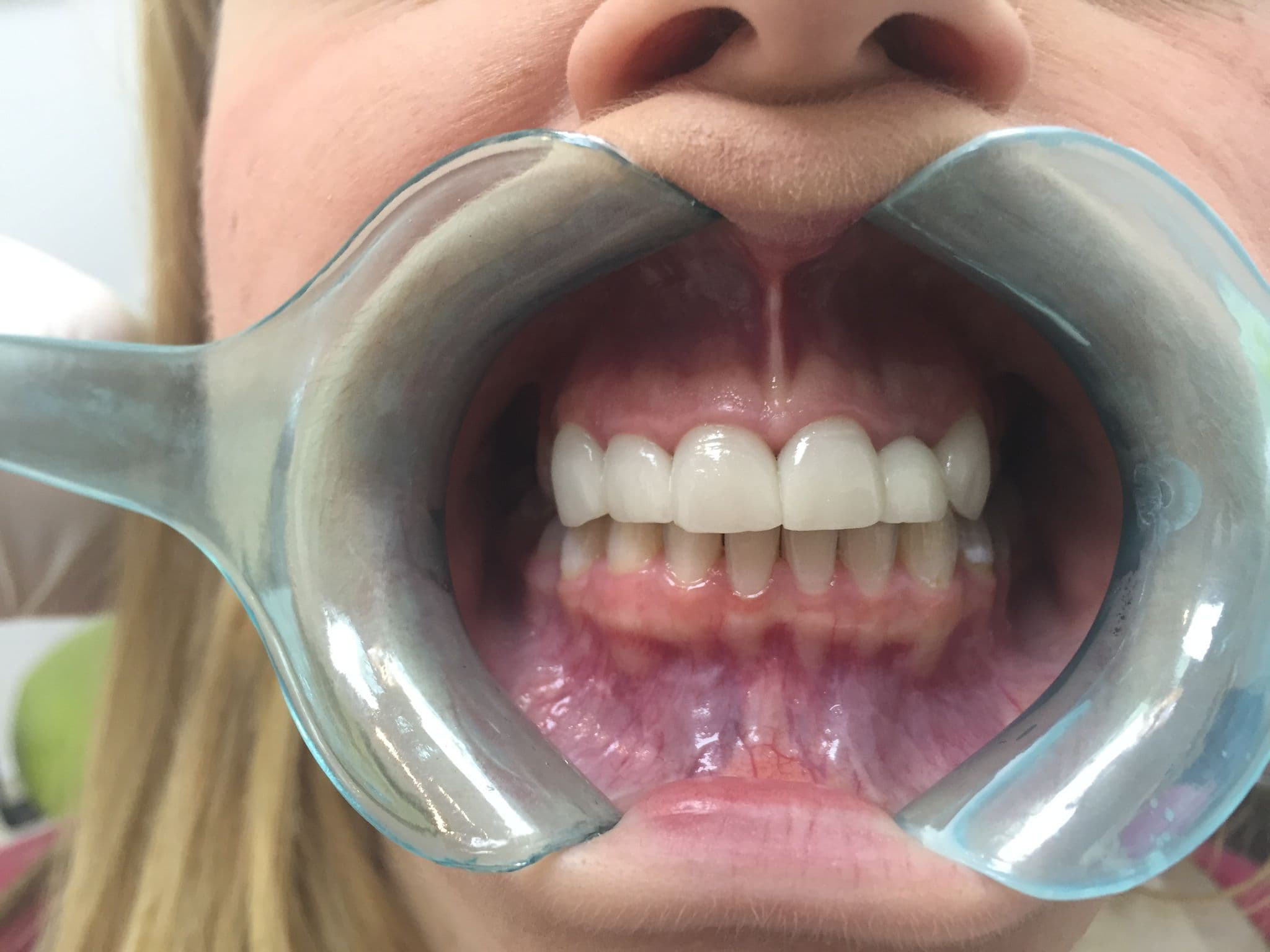 Composite Bonding: The Same-Day Smile Solution