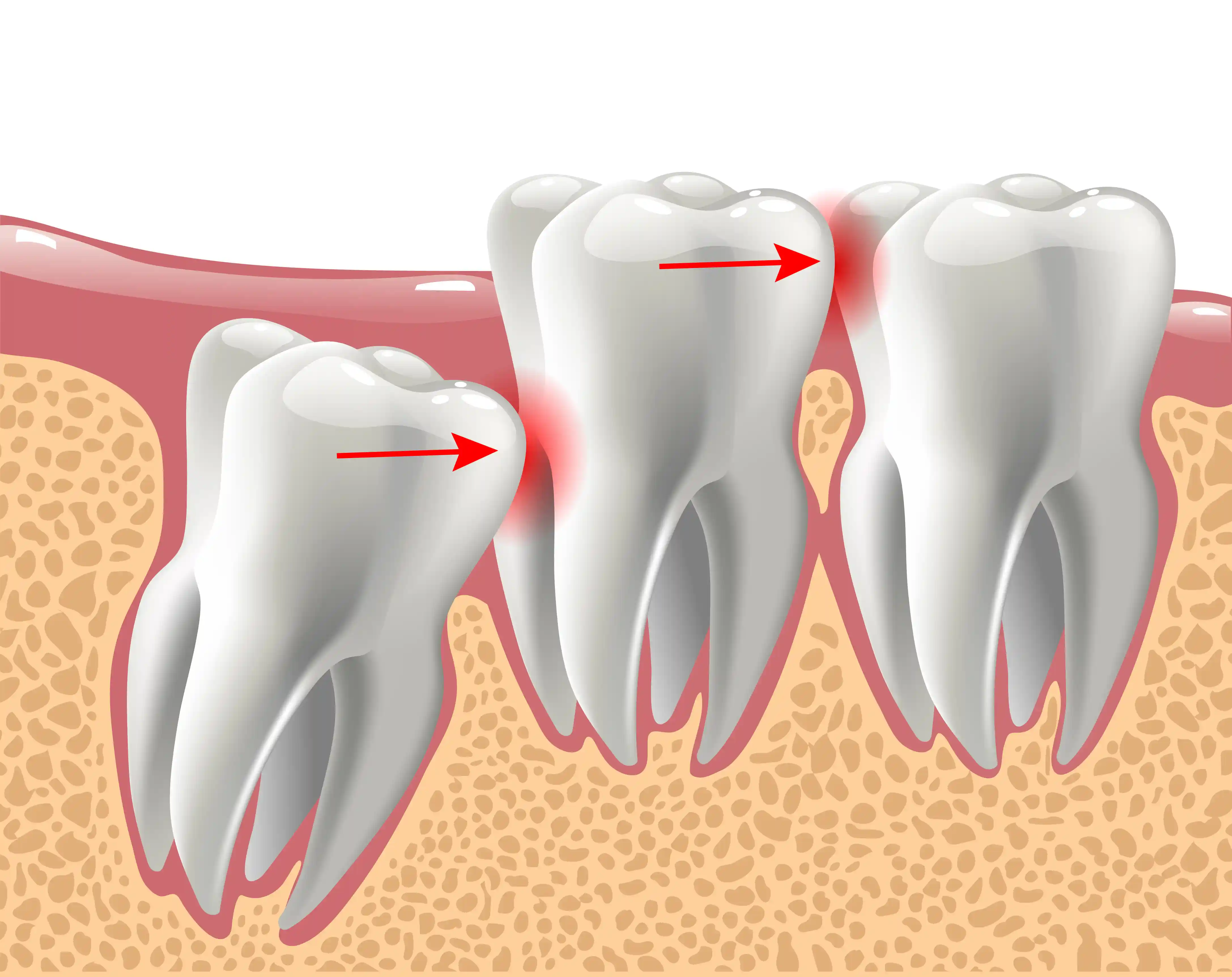 Impacted Wisdom Teeth: 7 Hidden Risks of Waiting Too Long to Remove Them