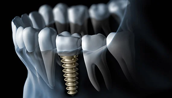 Dental Implants