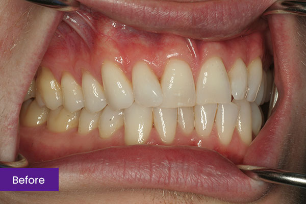 Invisalign Before