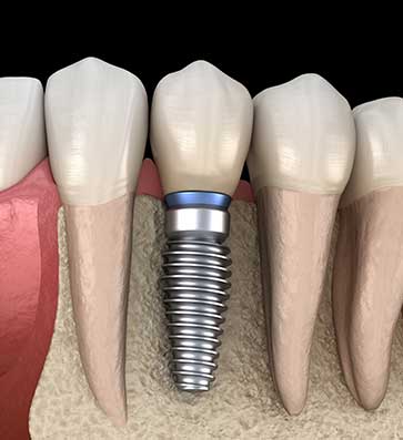 Dental Implants