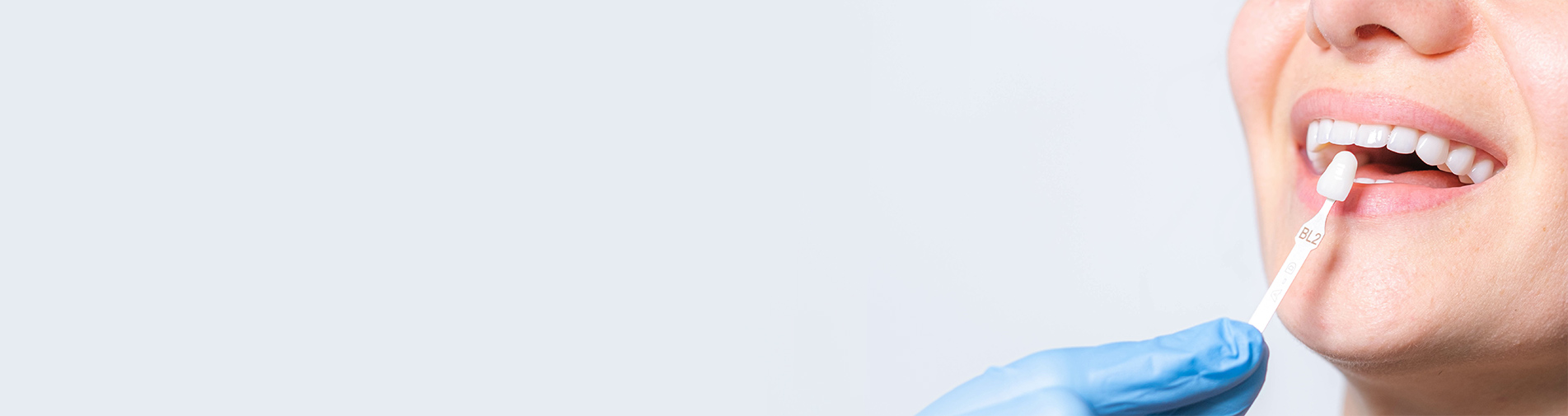 Cost of Porcelain Veneers