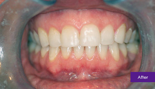 Invisalign After 6